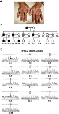 Whole-Exome Sequencing Identifies a Novel CPT2 Mutation in a Pedigree With Gout